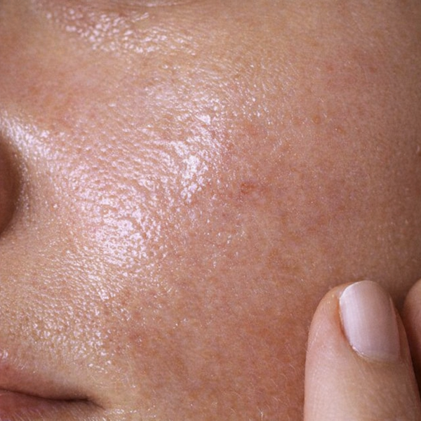 Oily Skin
